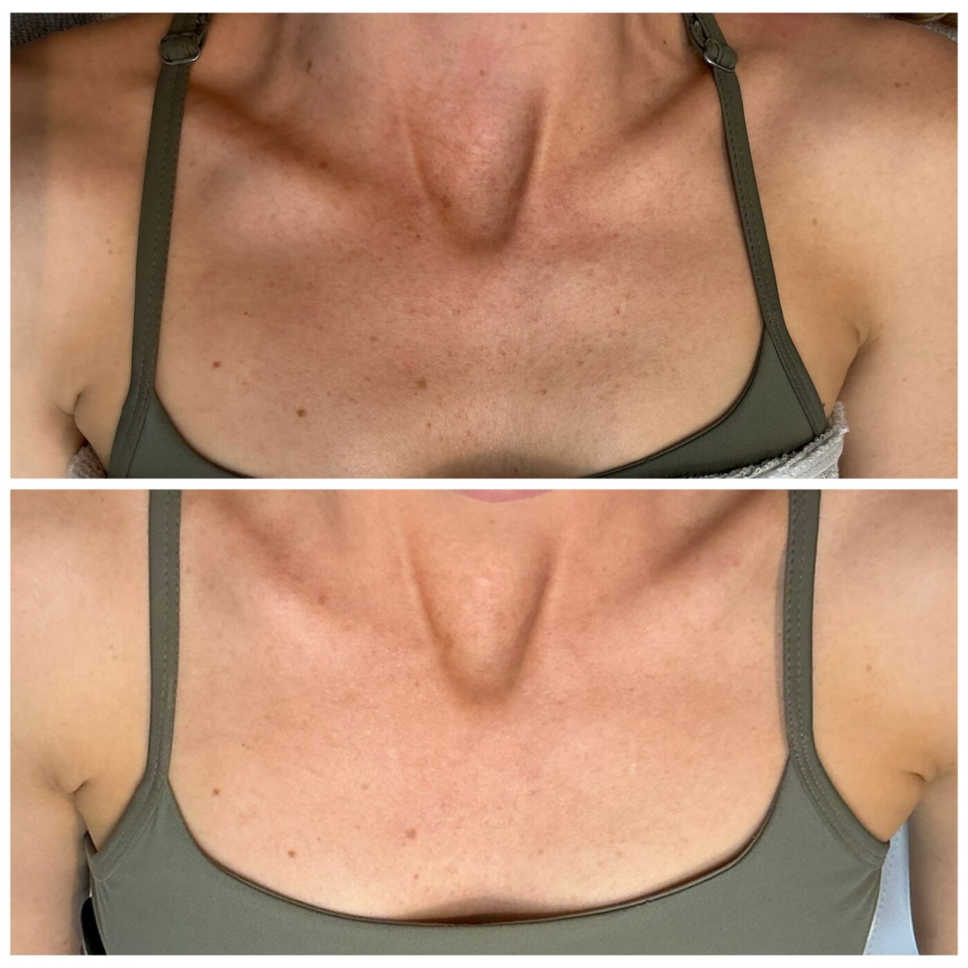 BBL Hero — décolletage before and after, Skin By Olivia Wānaka