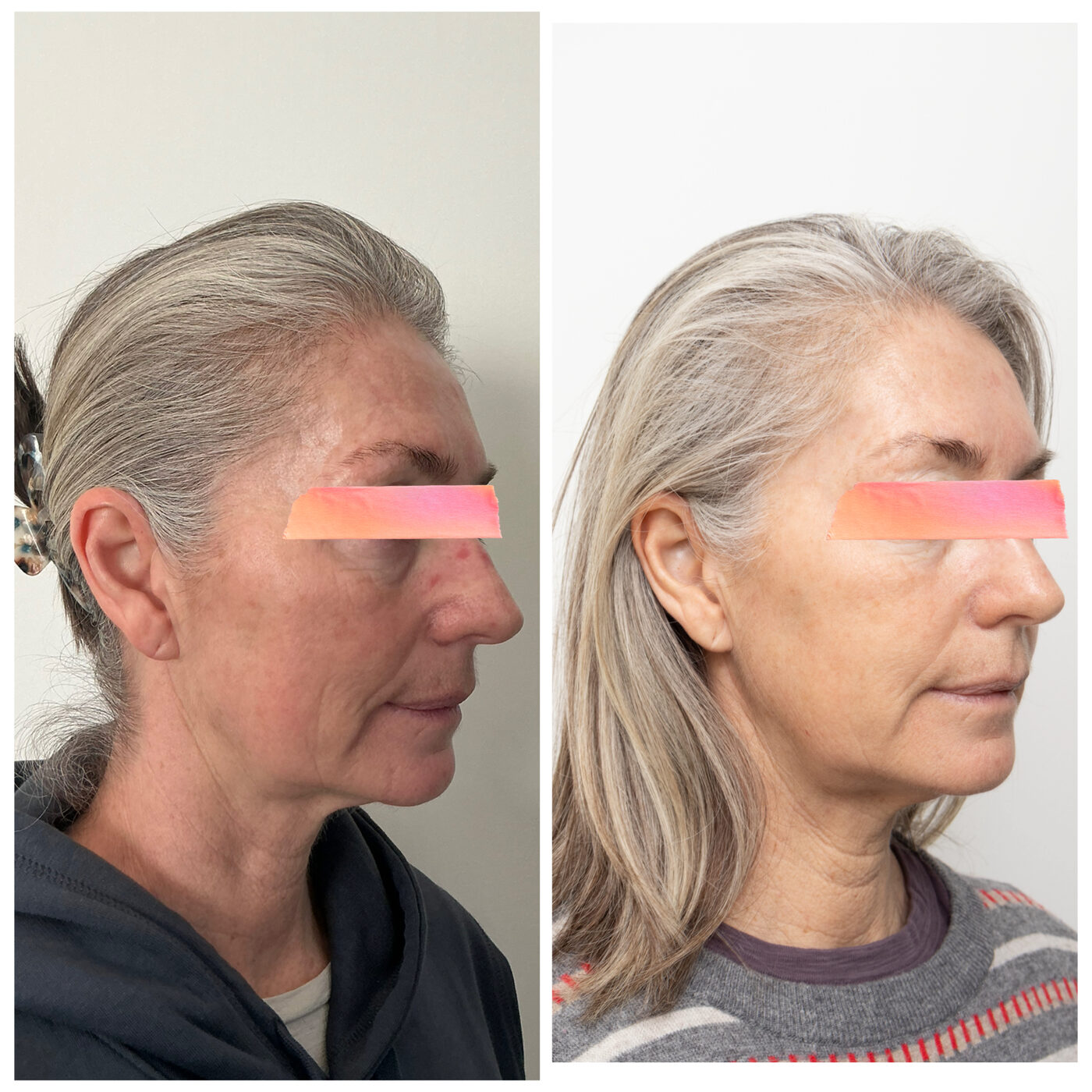 BBL Hero and Moxi before and after, Skin By Olivia Wānaka