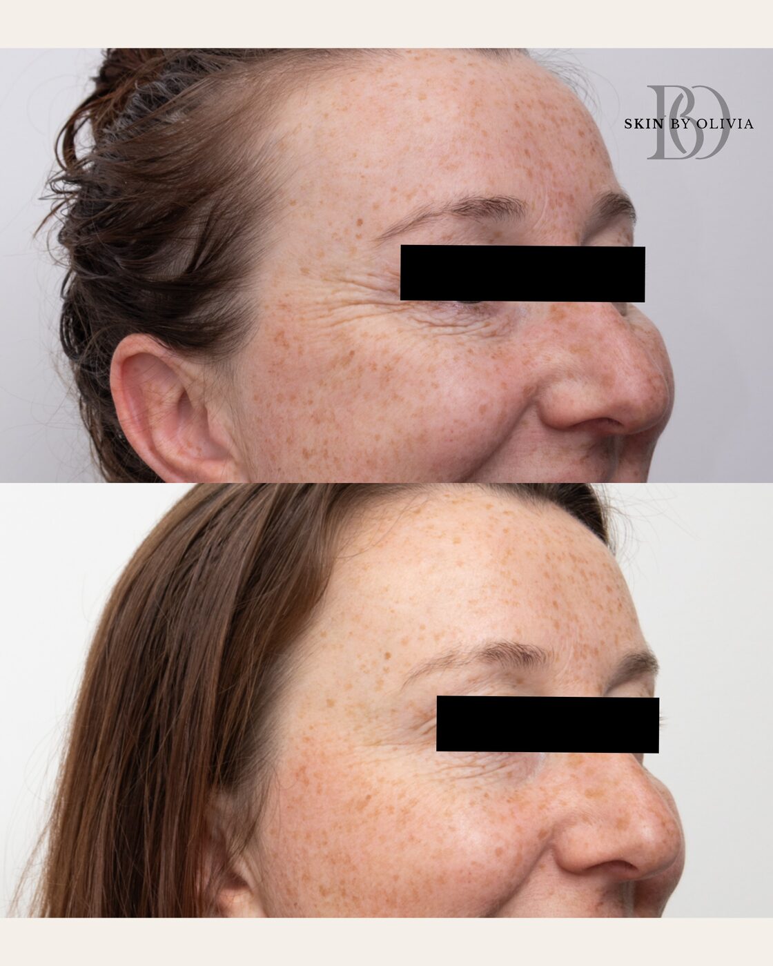 Anti-wrinkle — crow's feet before and after, Skin By Olivia Wānaka
