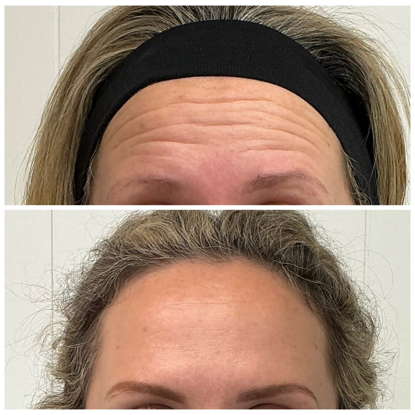 Anti-wrinkle — forehead lines before and after, Skin By Olivia Wānaka