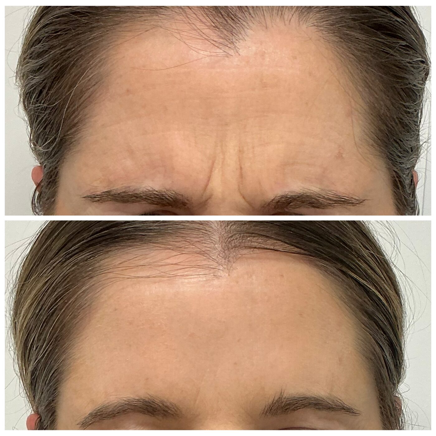 Anti-wrinkle — frown lines before and after, Skin By Olivia Wānaka
