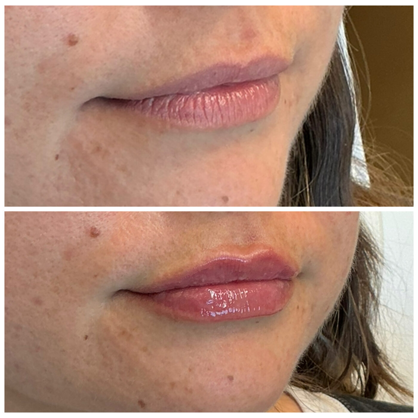 Lip filler — 0.5ml before and after, Skin By Olivia Wānaka